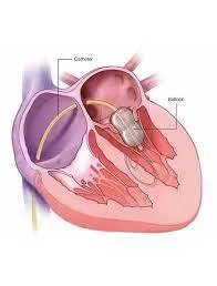 Balloon mitral valvotomy